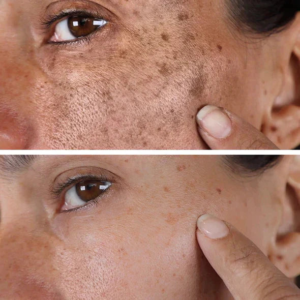 ✨Seurico™ Rapid Dark Spot Eraser – Melanin Correcting Facial Serum🔥